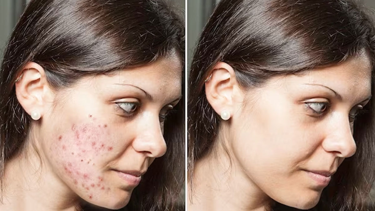 Clove Oil To Remove Acne Pimples In Hindi